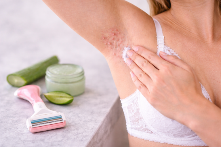 Frau trägt beruhigende Creme auf gereizte Achsel mit Rasierpickeln nach der Rasur auf