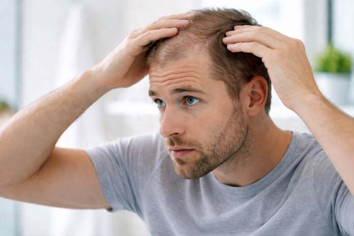 Mann betrachtet seinen zurückweichenden Haaransatz im Spiegel – Haarausfall bei Männern